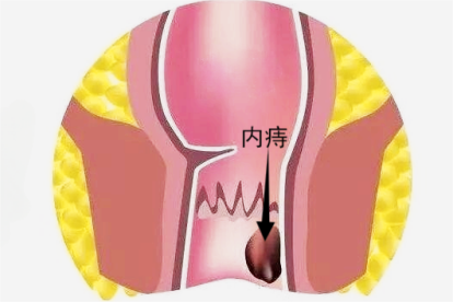 内痔图片