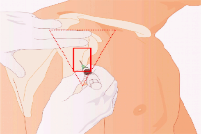 注射正确部位的图片