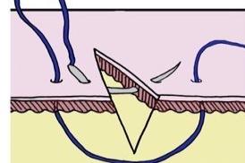垂直褥式内翻缝合图片