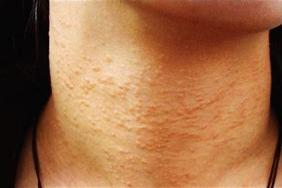 脖子毛周角化症图