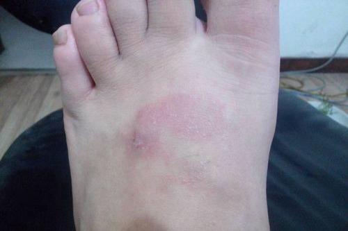 脚背上癣的图片