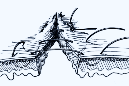 连续水平褥式内翻缝合图片