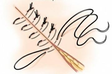 平行外翻缝合图片