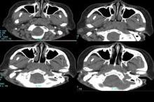 上颌窦CT示意图