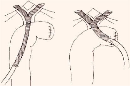 胆管空肠Roux-en-Y吻合术示意图