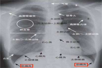 肋膈角位置图解