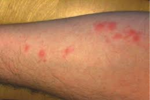 被蝼蛄咬伤后的图片