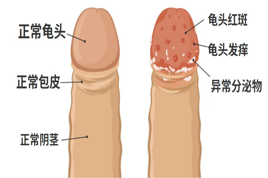 龟头霉菌感染症状图片