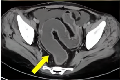 乙状结肠CT图片