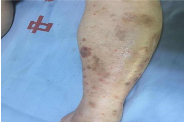 糖尿病皮肤病变糖斑的图片