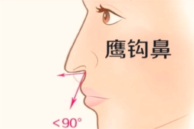 鹰钩鼻图片