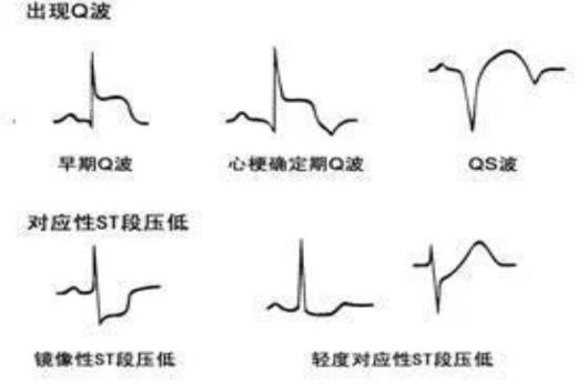 出现Q波图片
