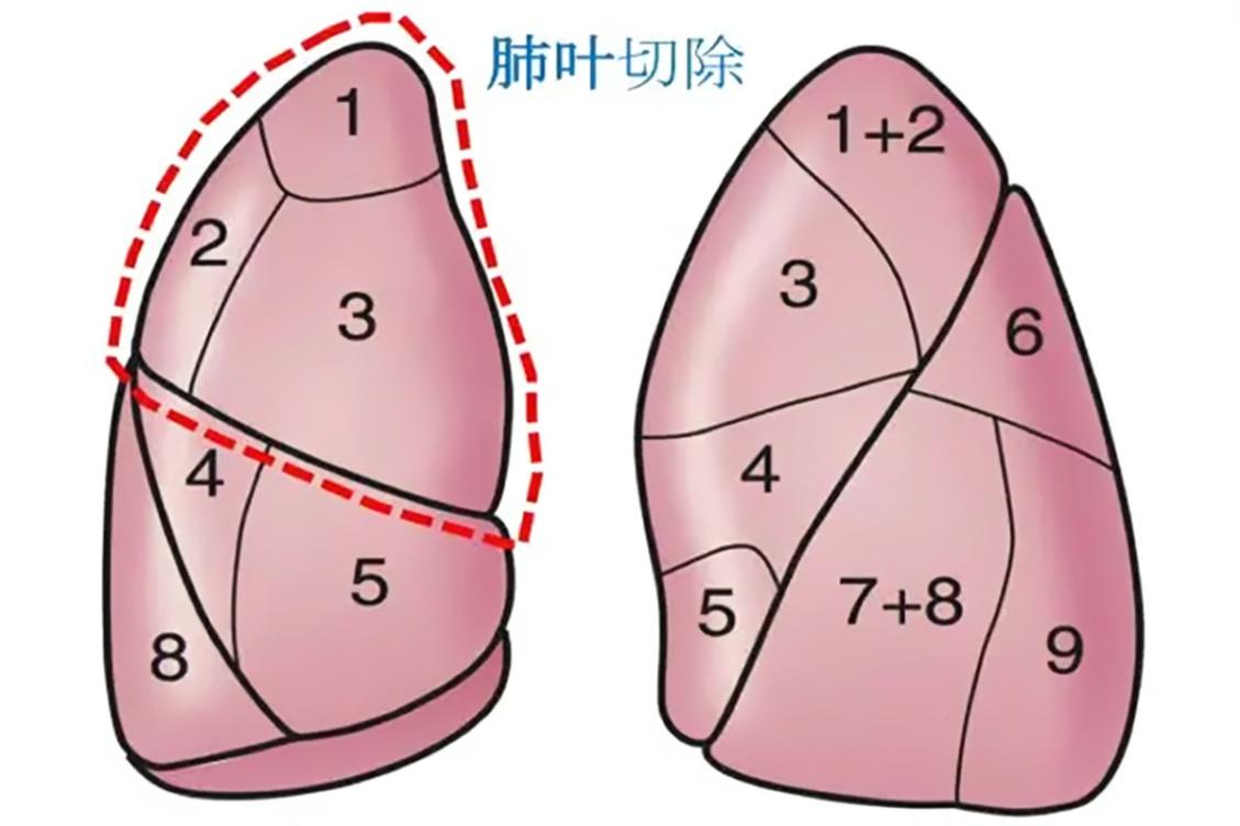 袖式肺叶切除术示意图