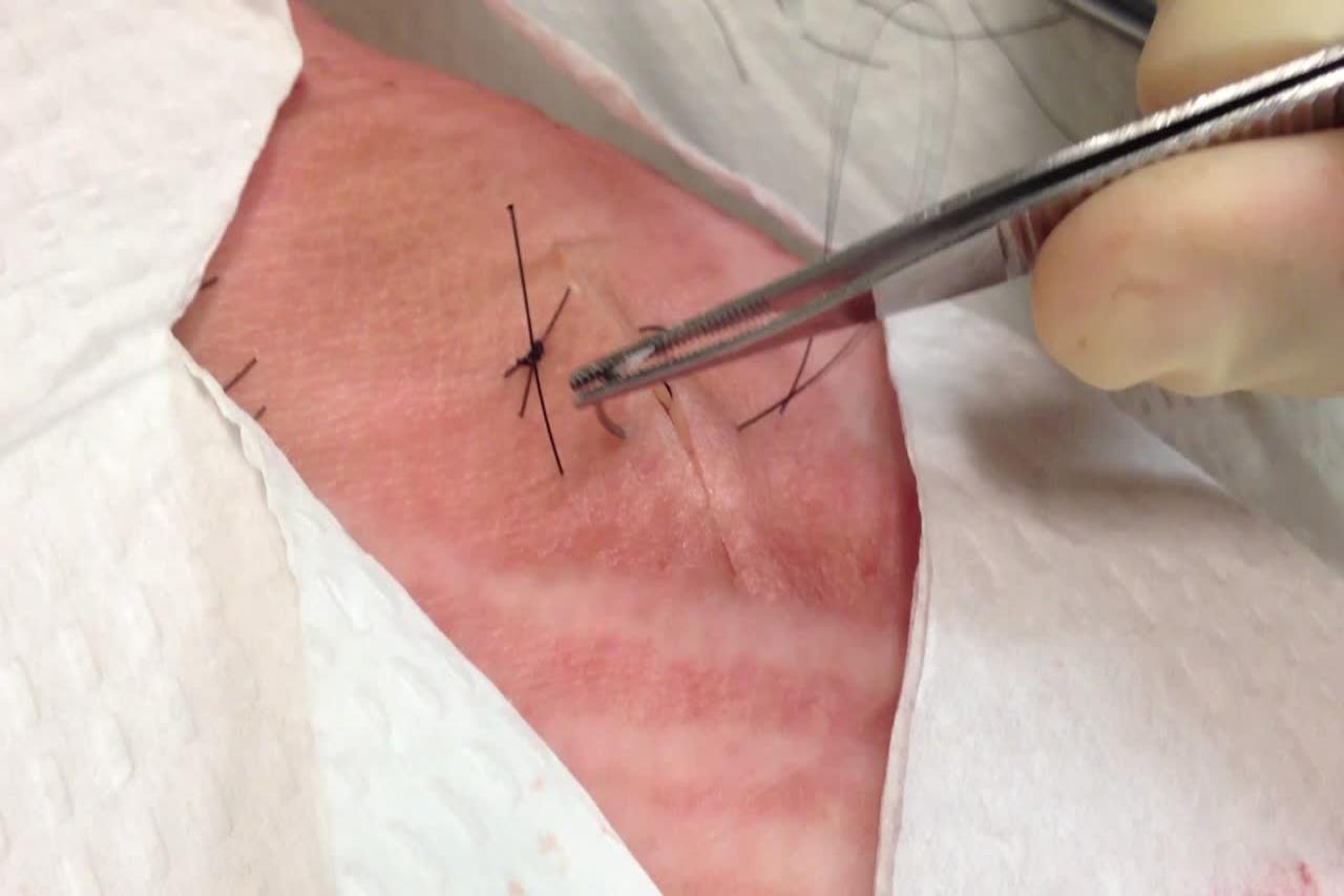 垂直外翻缝合图片