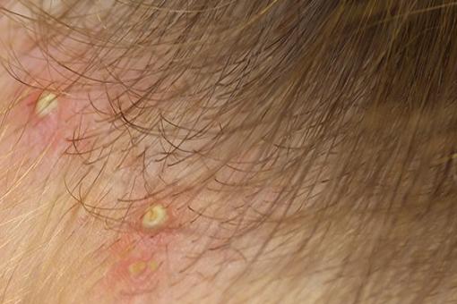 金黄色葡萄球菌性毛囊炎图片