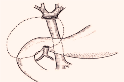 胆管空肠Roux-en-Y吻合术示意图