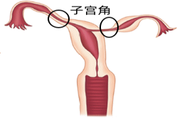 子宫角位置图