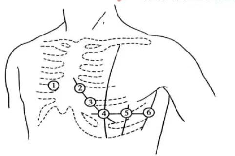 胸导联V1到V6的位置图