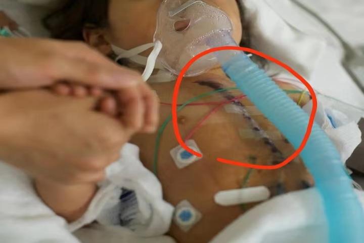 儿童先心病开胸手术瘢痕图