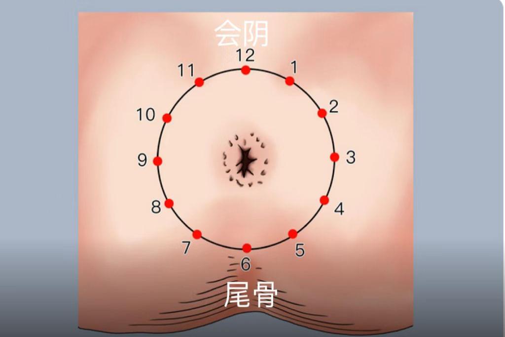 肛门时钟定位法图