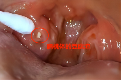 扁桃体有豆腐渣图片
