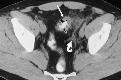 乙状结肠CT图片