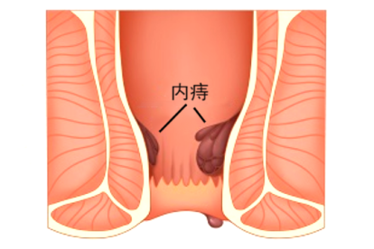内痔图片
