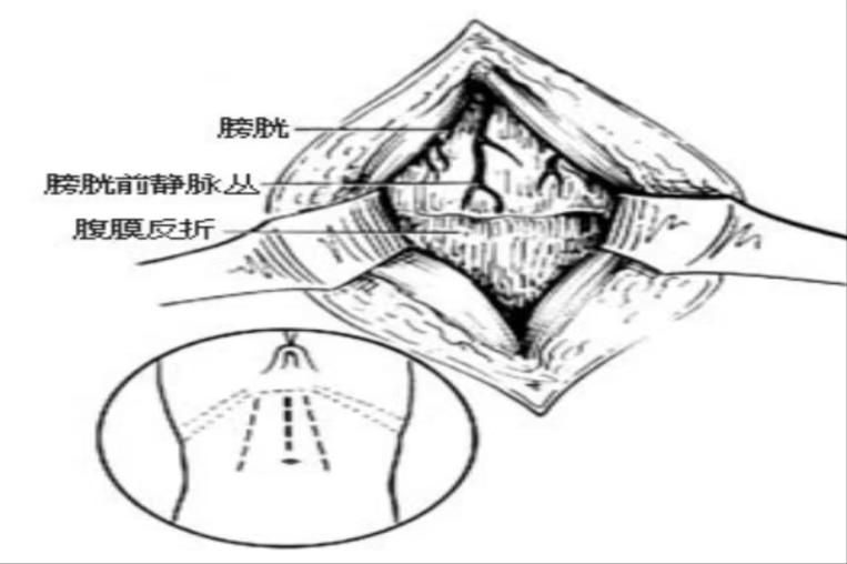 显露膀胱图