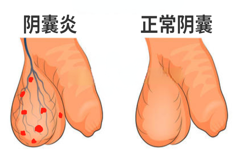 阴囊炎图片
