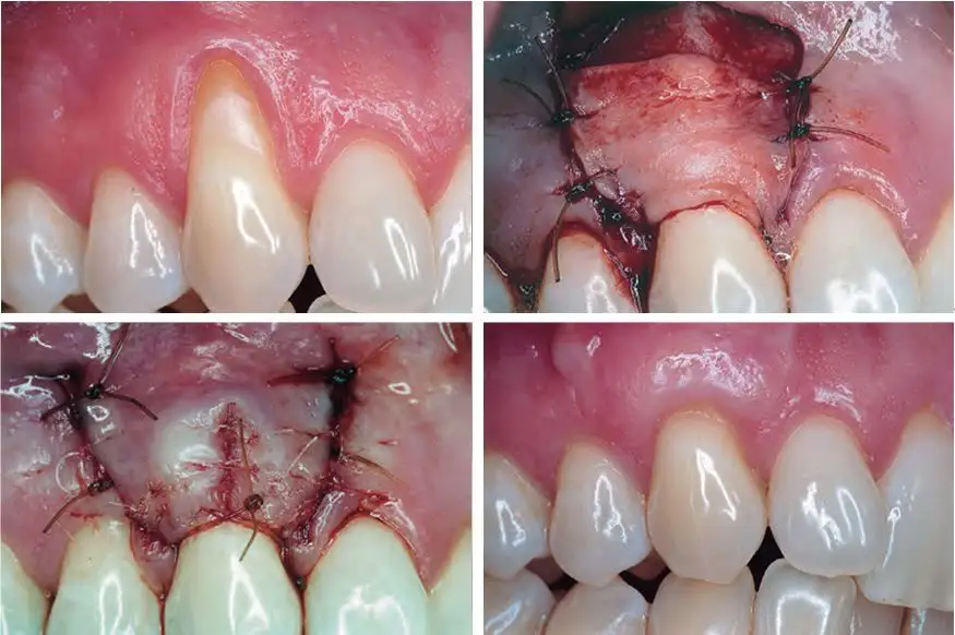 根向复位瓣手术步骤图