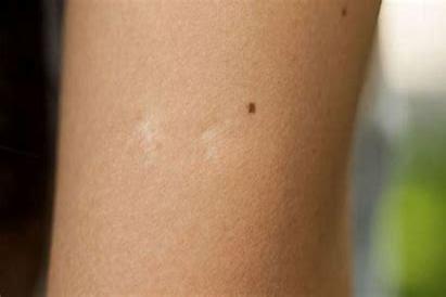 卡介苗正常疤痕图片