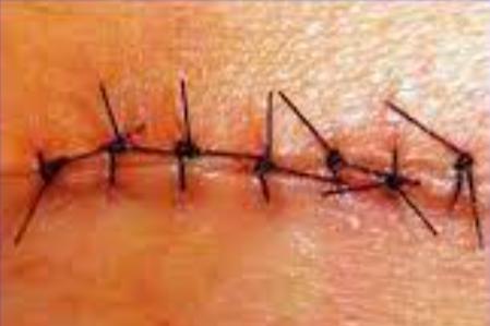 单纯间歇缝合图片