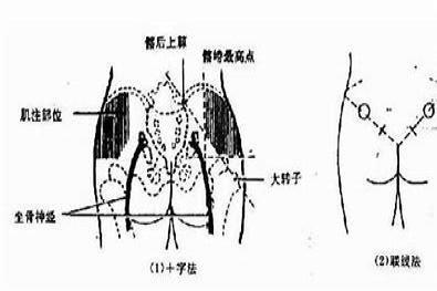 髂嵴下缘位置图片