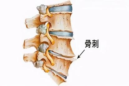 颈椎前缘骨刺图片