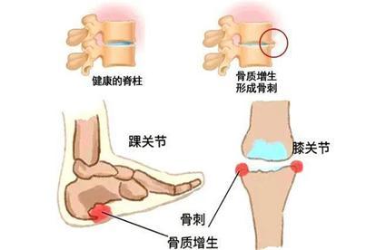 骨刺剧烈疼痛的原因