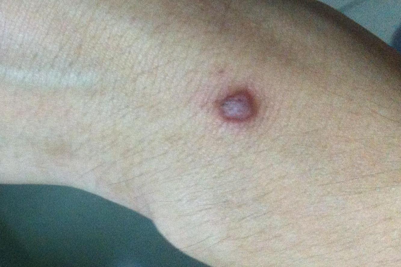 手腕鱼鳞痣图片