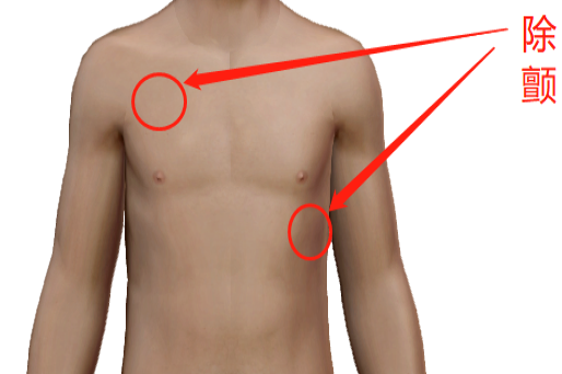 除颤位置放置部位图片