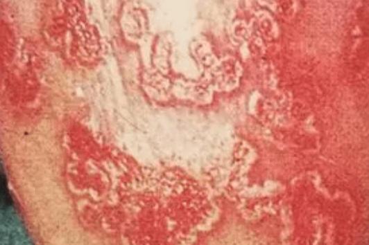 环状溃疡性龟头炎