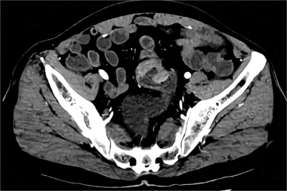 乙状结肠CT图片