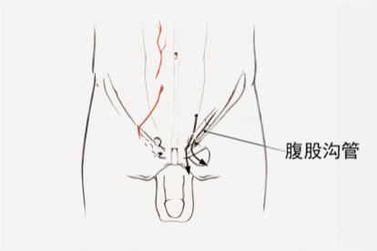 腹股沟管位置图
