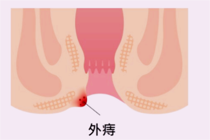 外痔图片