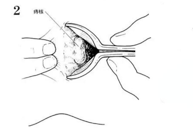 痔疮外剥内扎术图解