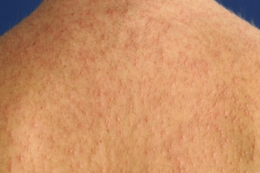 马拉色菌毛囊炎图片