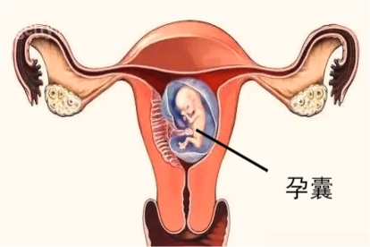 孕囊在子宫位置图