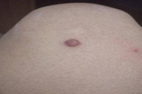 腿部鱼鳞痣图片