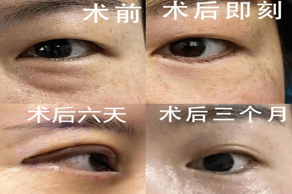 外切眼袋恢复过程的图片