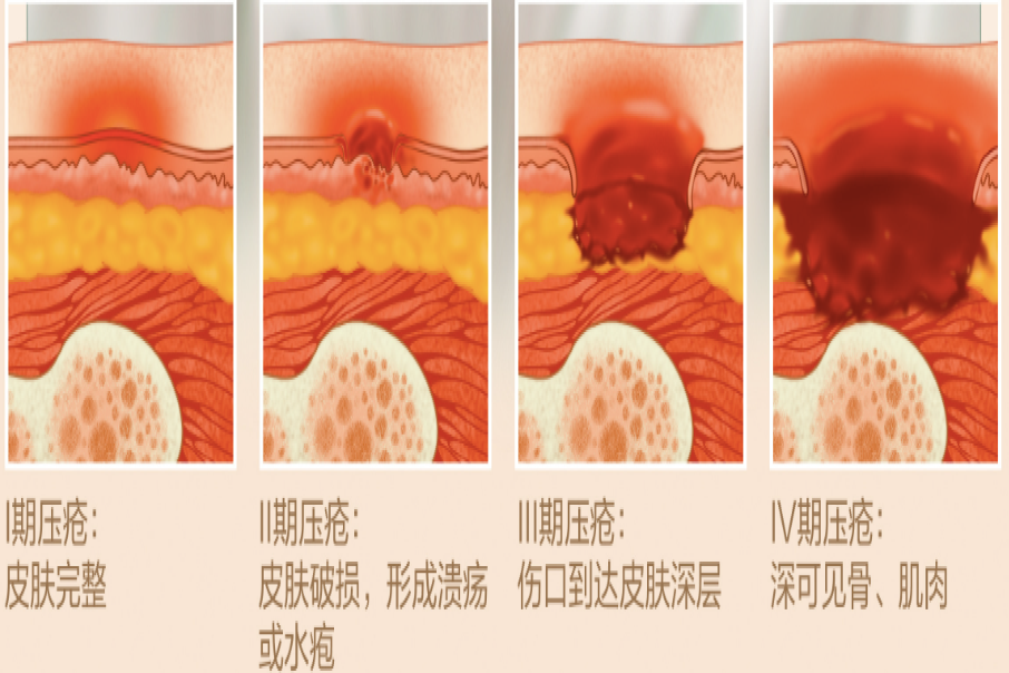 压疮分期图