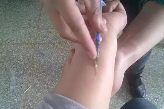 皮试的进针手法图片