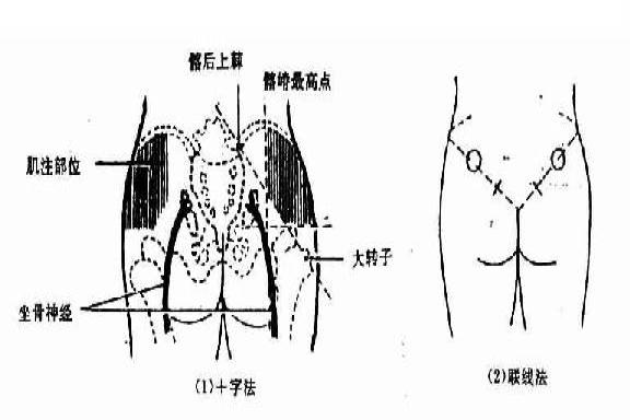 臀部注射的部位及定位图片示意图