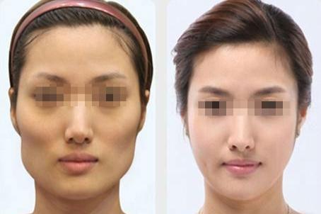 高低颧骨对比图片